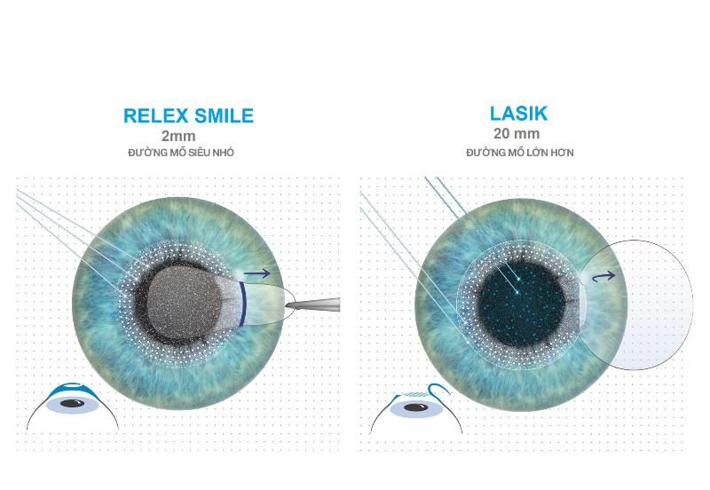 Biểu đồ hoặc bảng so sánh chi phí ước tính của các phương pháp mổ cận thị (PRK, LASIK, Femto LASIK, SMILE)